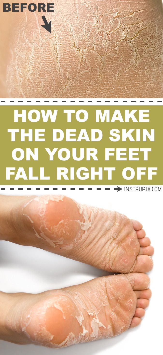 10 Ways to Dissolve (and Prevent) Dead Skin Buildup on Your Feet