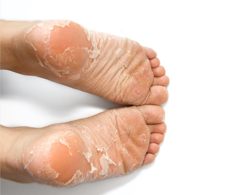 Foot Soak For Dead Skin That Actually Works