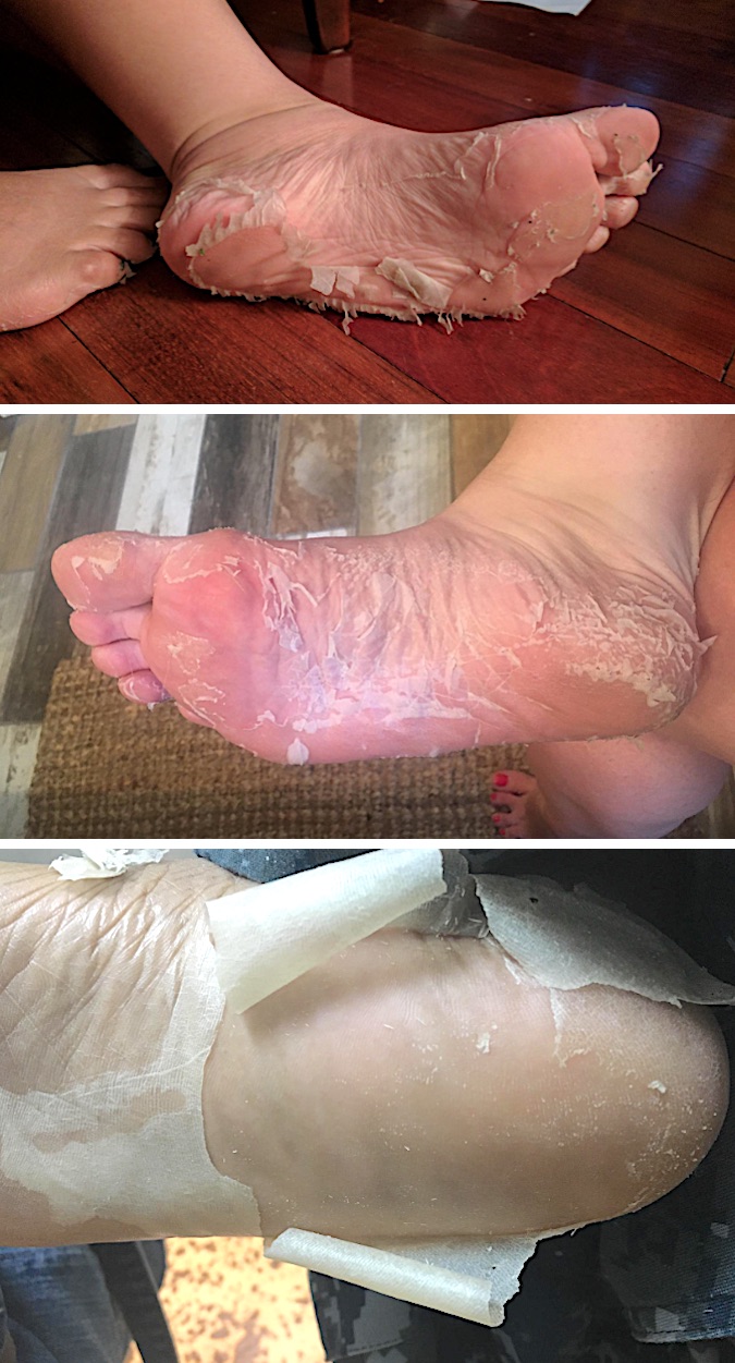 DIY Listerine Dead Skin Remover Foot Soak - STOCKPILING MOMS™