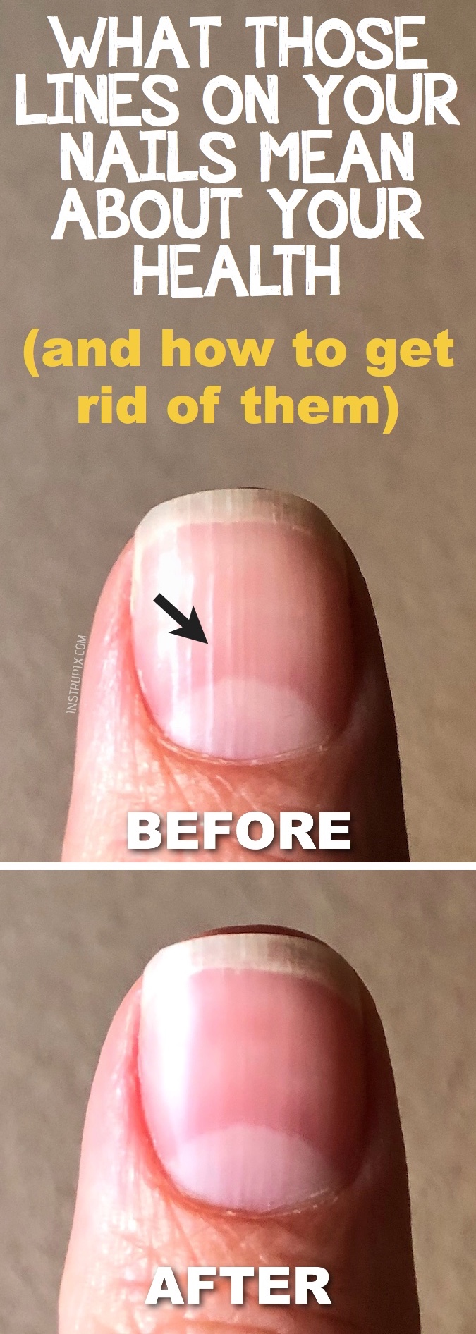 What are those vertical lines on your nails, and what it means about your health? Instrupix.com